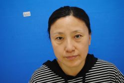 -天津健丽·去眼袋医疗美容机构