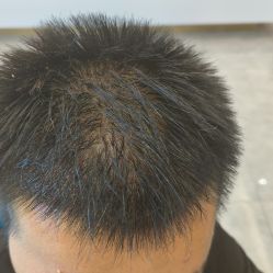 -碧莲盛·不剃发植发