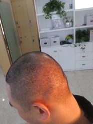 点击看大图 -大麦微针植发丨全国连锁