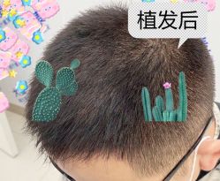 -大麦微针植发全国连锁