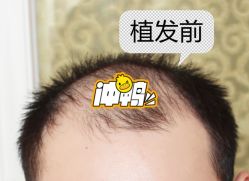 -大麦微针植发全国连锁