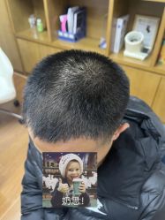 -大麦微针植发全国连锁