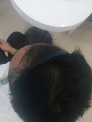 -大麦微针植发丨全国连锁
