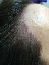 刚刚做完 发际线 没把做前得拍下…-平萍纹绣韩式半永久定妆