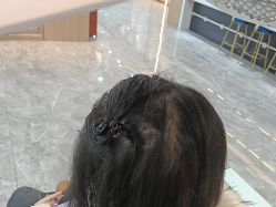 -碧莲盛·不剃发植发