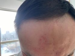 -爱莎扁平疣·汗管瘤·斑痣中心