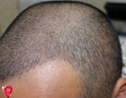 -大麦微针植发丨全国连锁