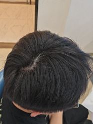 -大麦微针植发丨全国连锁