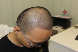 -大麦微针植发丨全国连锁