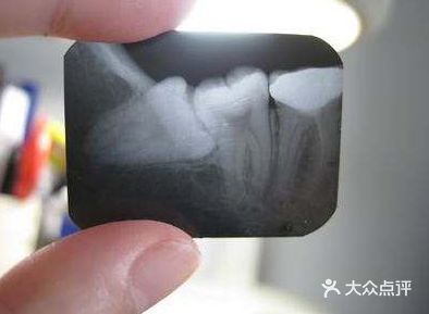 智齿长出来会挤歪其他牙齿吗？