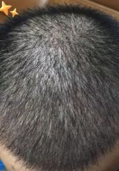 -大麦微针植发丨全国连锁