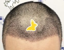 -大麦微针植发全国连锁