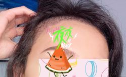 -大麦微针植发全国连锁