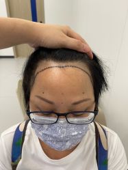 体验前-大麦微针植发全国连锁