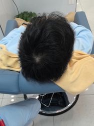 -大麦微针植发丨全国连锁