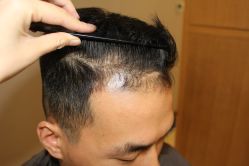 -大麦微针植发丨全国连锁