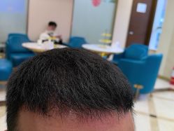-碧莲盛·不剃发植发