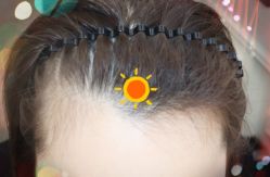 -大麦微针植发全国连锁