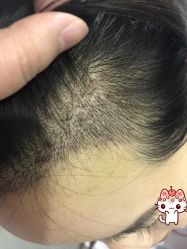 -大麦微针植发丨全国连锁