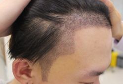 -大麦微针植发全国连锁