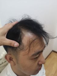 点击看大图 -大麦微针植发丨全国连锁