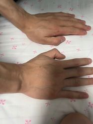 体验前-嘉和医学脱毛中心