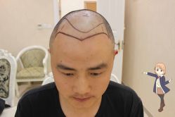 -大麦微针植发丨全国连锁