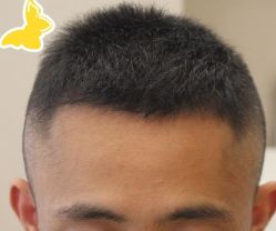 -大麦微针植发丨全国连锁