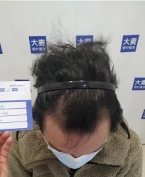 -大麦微针植发丨全国连锁