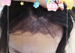 -大麦微针植发全国连锁