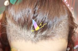 -大麦微针植发全国连锁