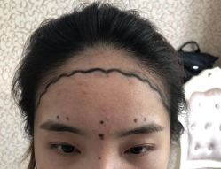 -大麦微针植发全国连锁