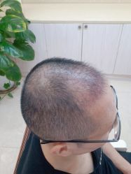 点击看大图 -碧莲盛·不剃发植发
