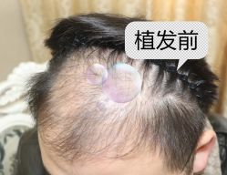 -大麦微针植发全国连锁