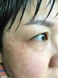 点击看大图 提斑做完当天-北京英煌医疗美容