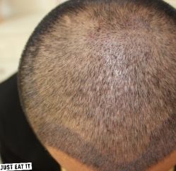 -大麦微针植发丨全国连锁