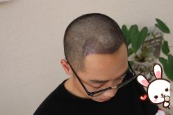 -大麦微针植发丨全国连锁