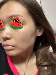 体验后-More摩尔医美の注射线雕光电中心