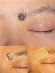-清疣美疣·痣·斑净肤中心