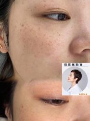 -美丽人生祛斑扁平疣汗管瘤中心