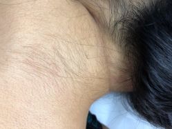 -薇兰专业脱毛连锁机构