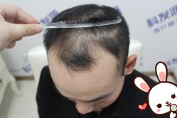 -大麦微针植发丨全国连锁