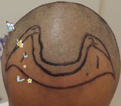 -大麦微针植发全国连锁