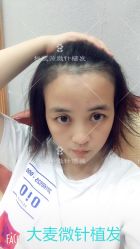 点击看大图 -大麦微针植发丨全国连锁