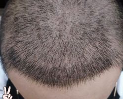 -大麦微针植发丨全国连锁