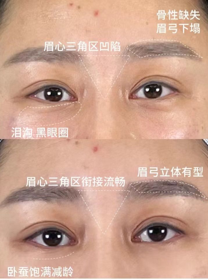 眉心三角区有些凹陷,眉弓也显得比较低平