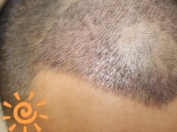 -大麦微针植发丨全国连锁