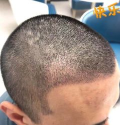 -大麦微针植发丨全国连锁