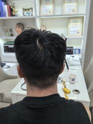 点击看大图 -大麦微针植发丨全国连锁
