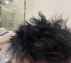 -碧莲盛·不剃发植发